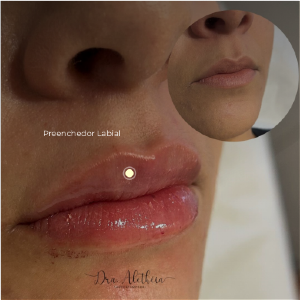 preenchimento-labial-com-cido-hialur-nico-1ml-dra-aletheia