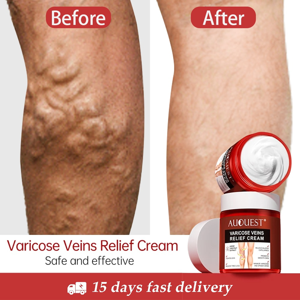 Varicosas veias alívio creme vasculite flebite aranha alívio da dor